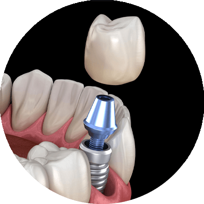 dental implant 3d graphic three components implant