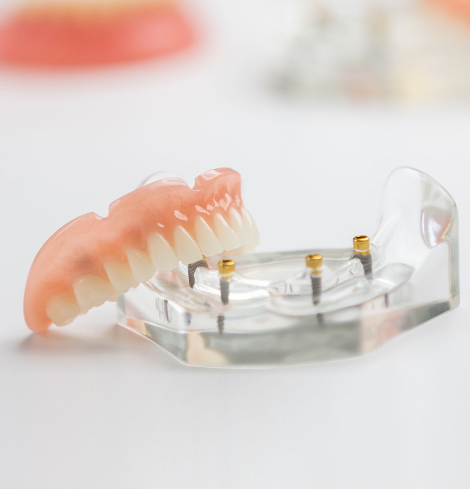 denture model sitting on counter top in dental office