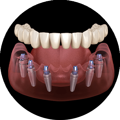 full mouth dental implants 3d model
