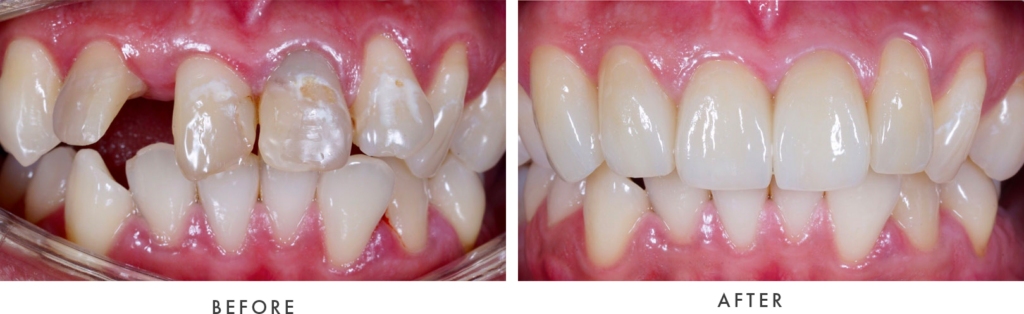 dental implants