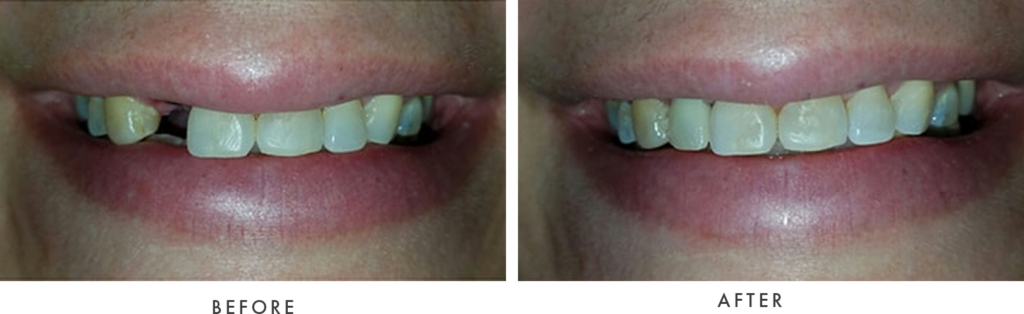 dental implants drgamburg