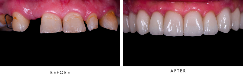 full mouth dental implants