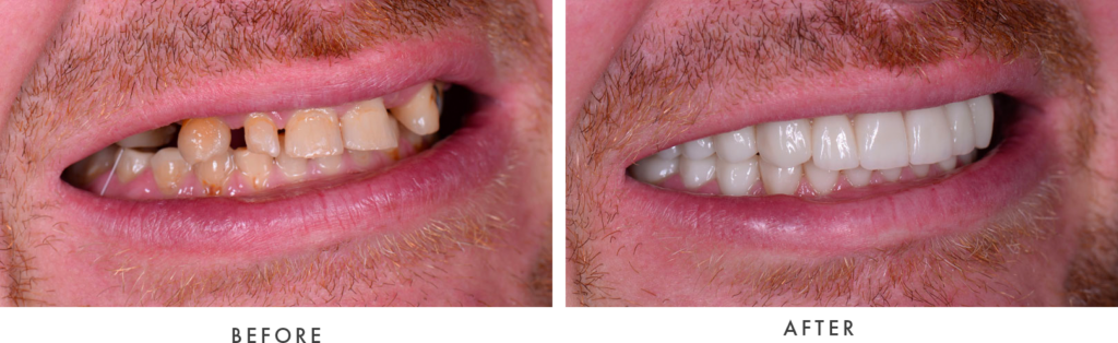 full mouth dental implants