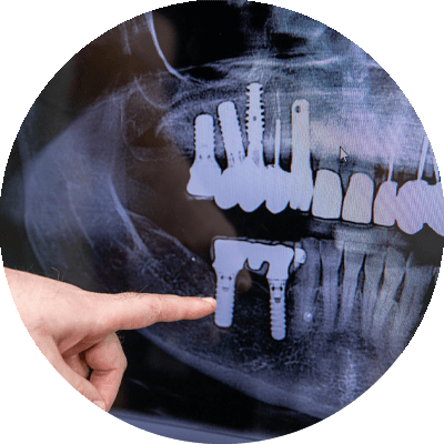 implants to be placed after removal