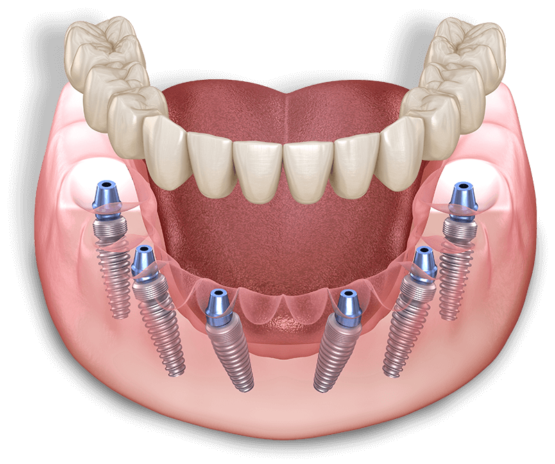 Full Mouth Dental Implant Model